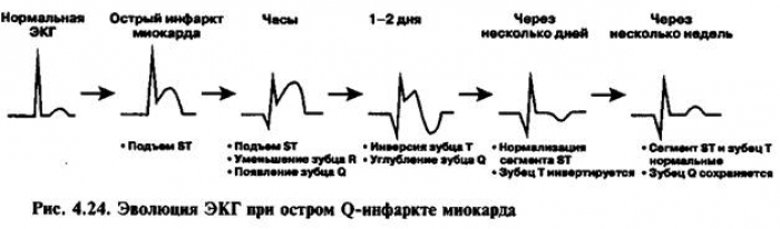 Окс экг картинки